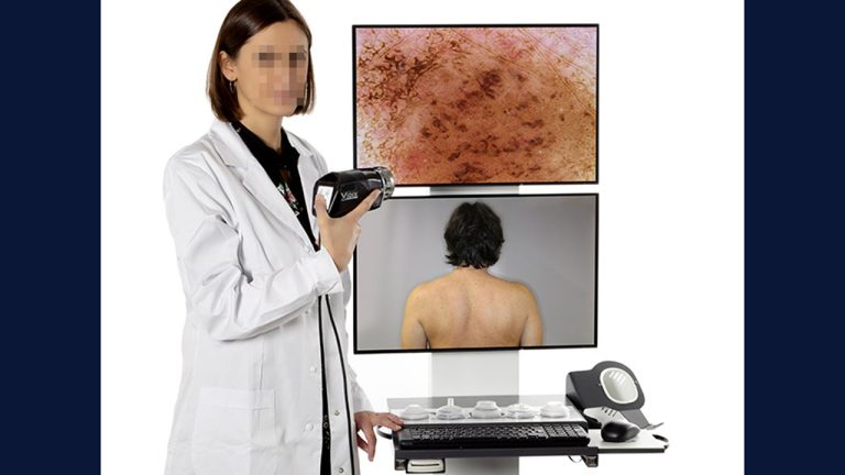 videodermatoscopio Orazio Capurro